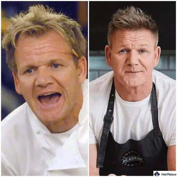 Gordon Ramsay hair transplant before and after