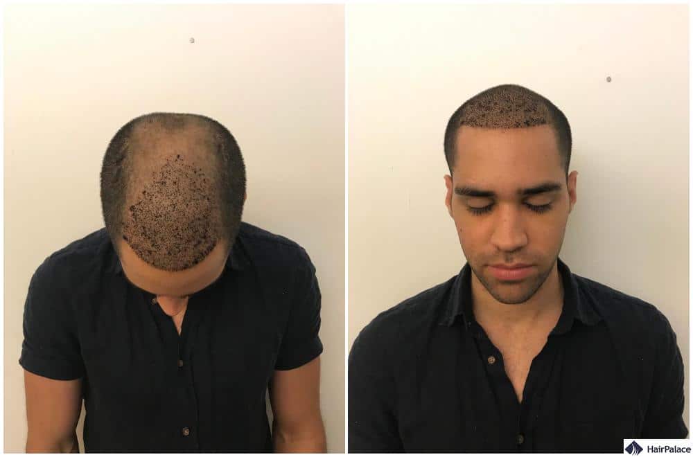 how a hair transplanbt looks after 1 week