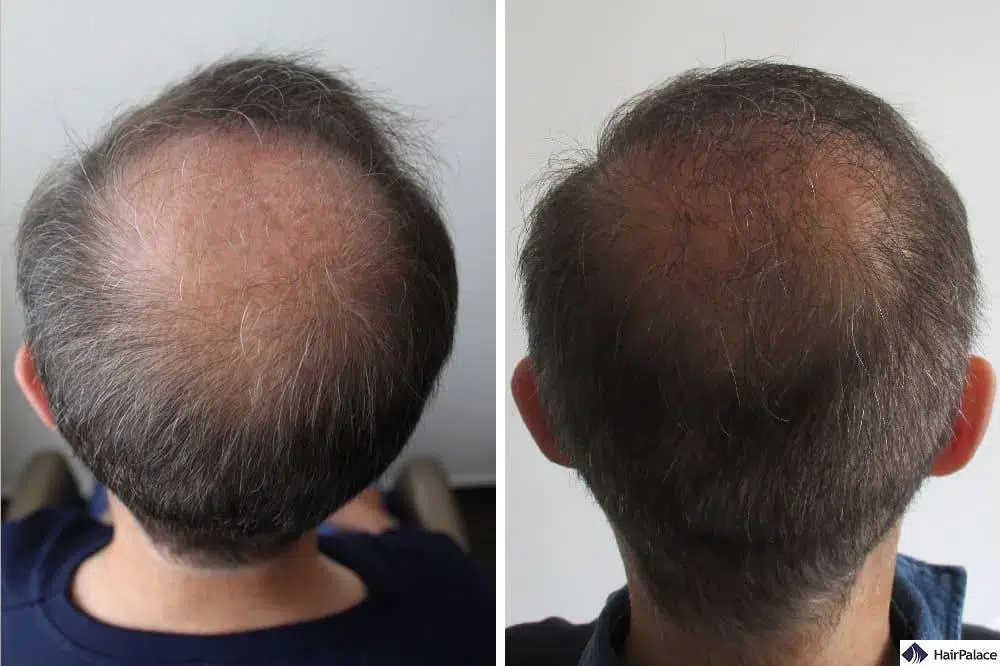 2000 grafts hair transplant crown