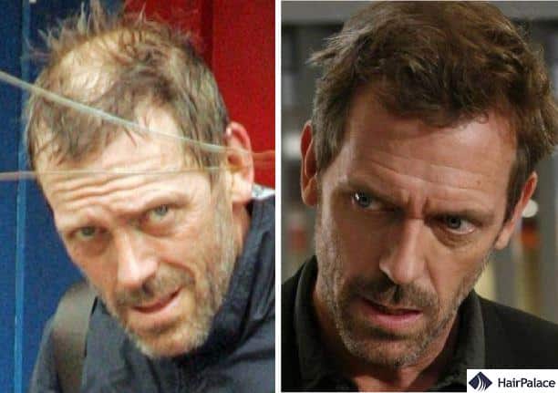 hugh laurie hair transplant beofre and after