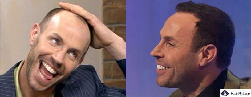 Jason gardiner hair transplant before and after