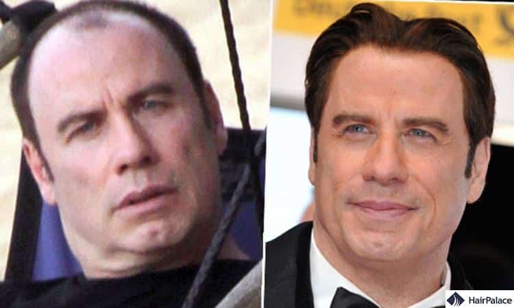 John Travolta hair transplant before and after