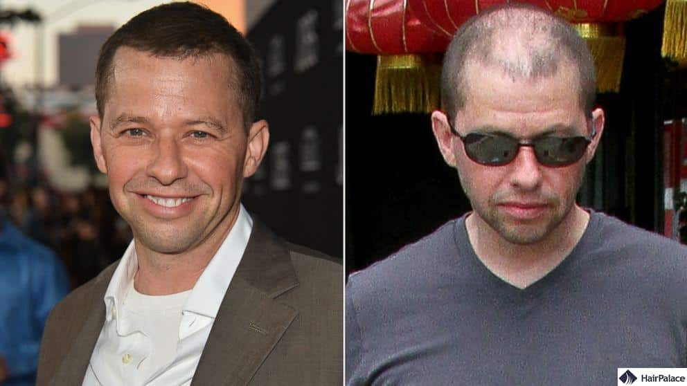 Jon Cryer hair transplant before and after