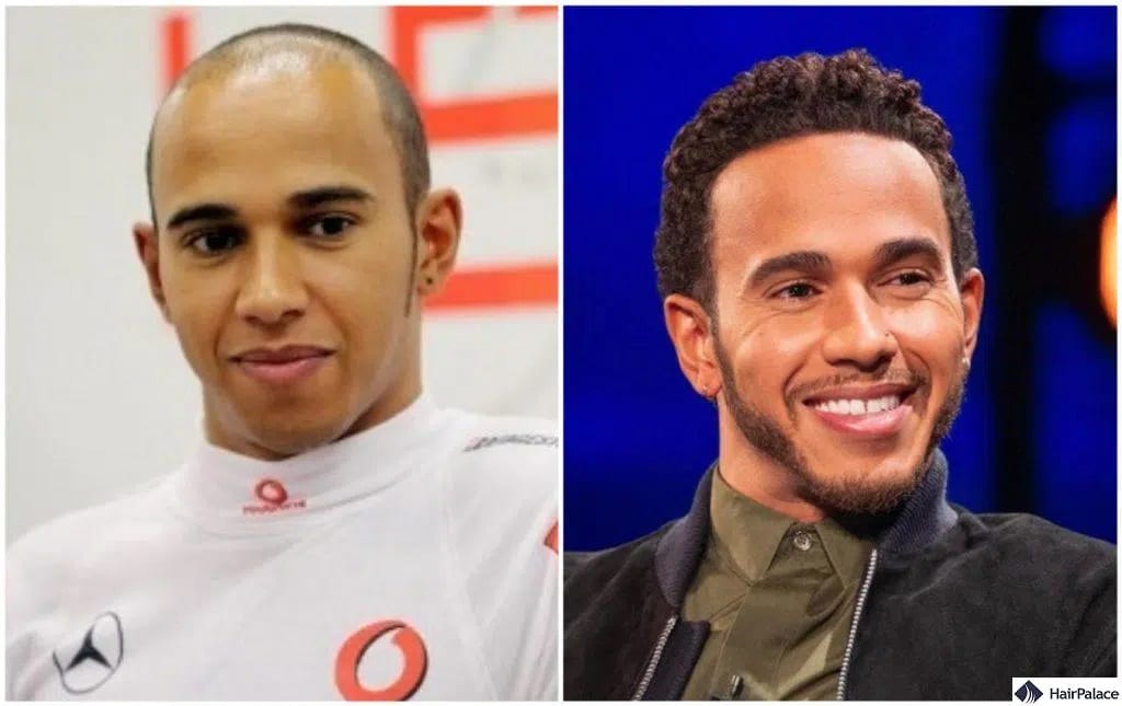 Lewis Hamilton hair transplant before an after