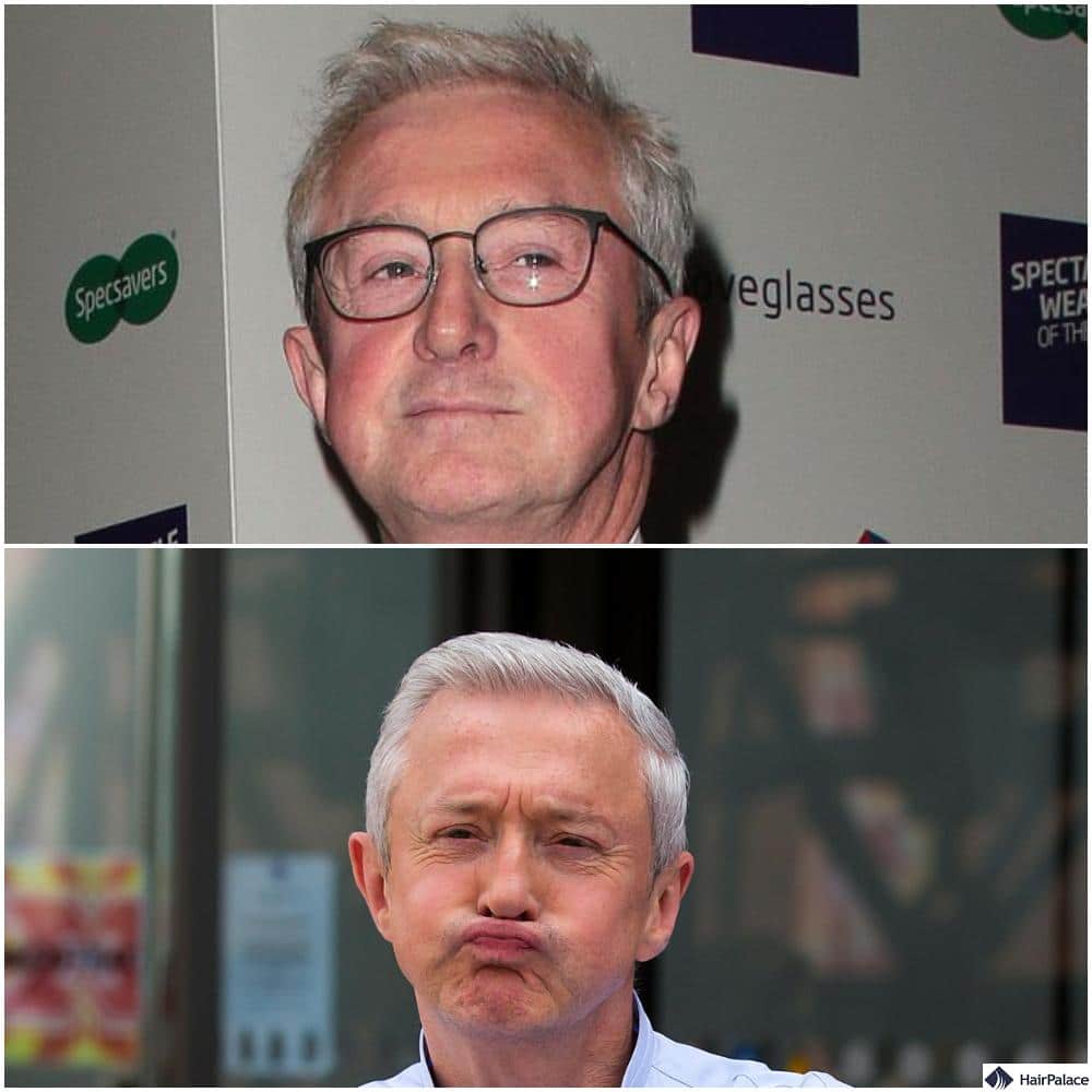 Louis Walsh hair transplant before and after