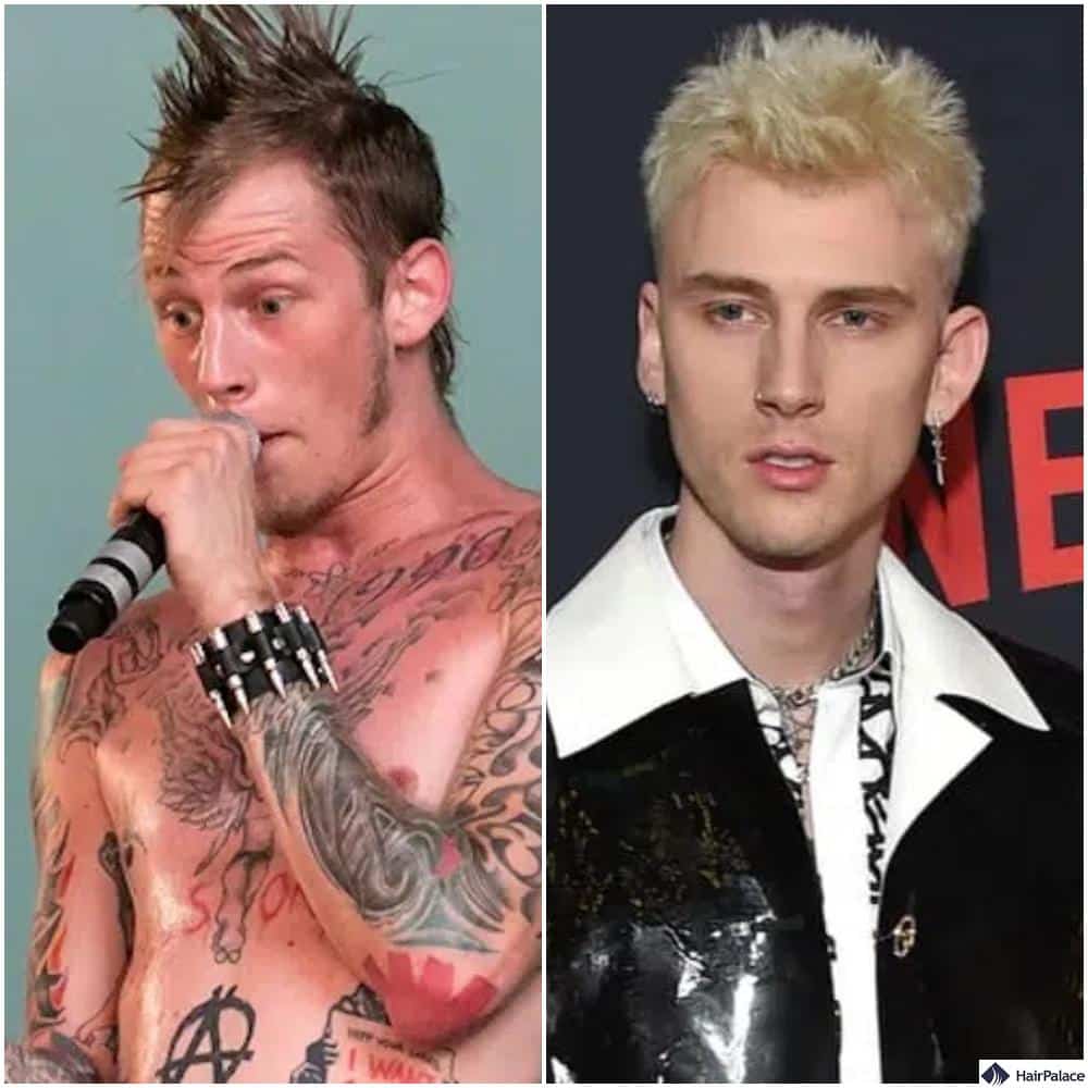 machine gun kelly hair transplant before and after