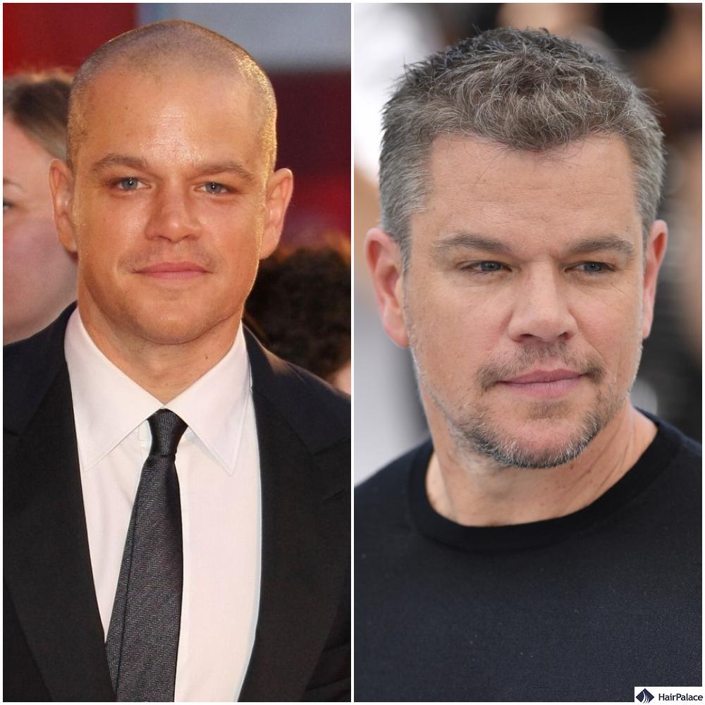 Best Celebrity Hair Transplant Before and After in 2023