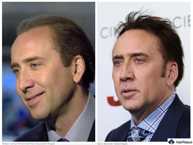 nicholas cage hair transplant before and after