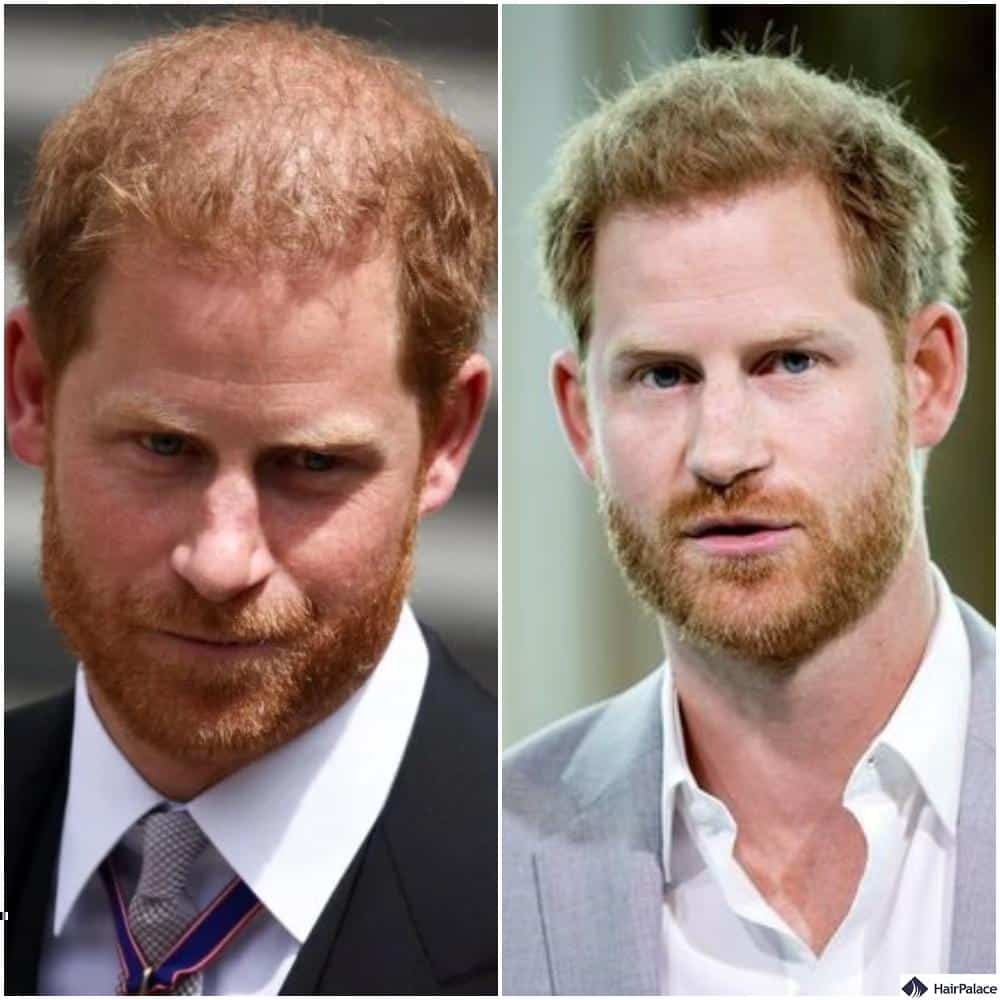 prince harry hair transplant before and after