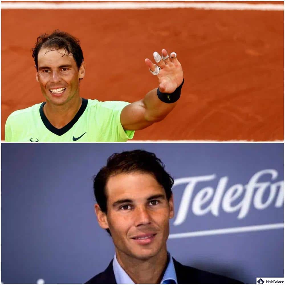 rafael nadal hair transplant before and after