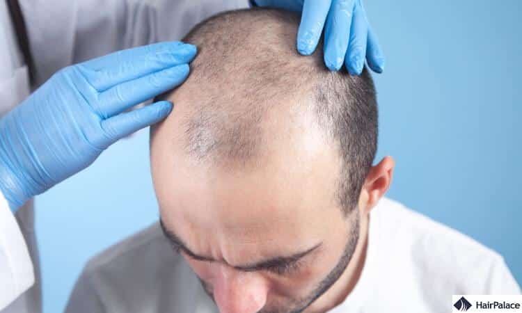 hair transplant consultation