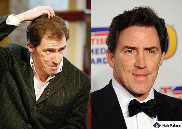 Rob brydon hair transplant before and after
