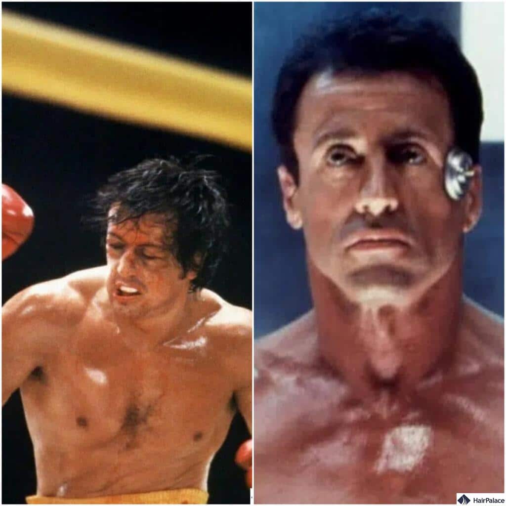 Sylvester Stallone is one of the first entries on our list of celebrity hair transplant results
