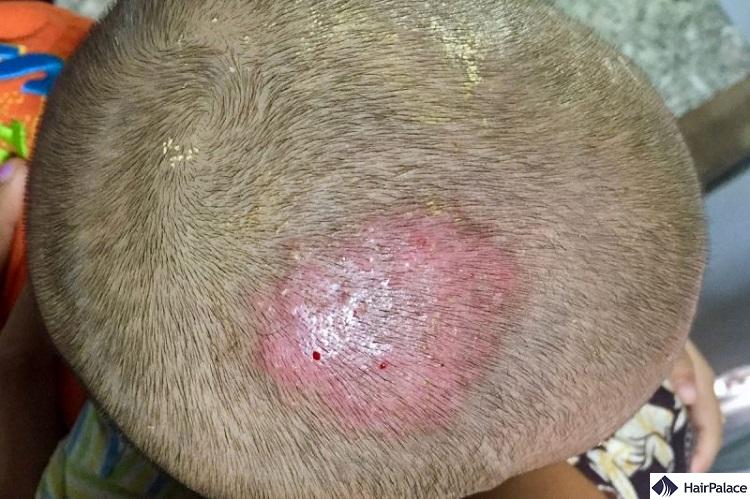 tinea capitis or ringworm can cause hair loss in children