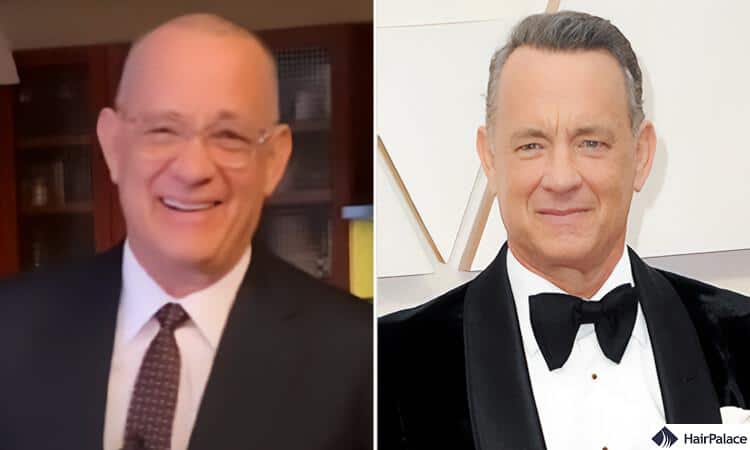 Tom hanks hair transplant before and after