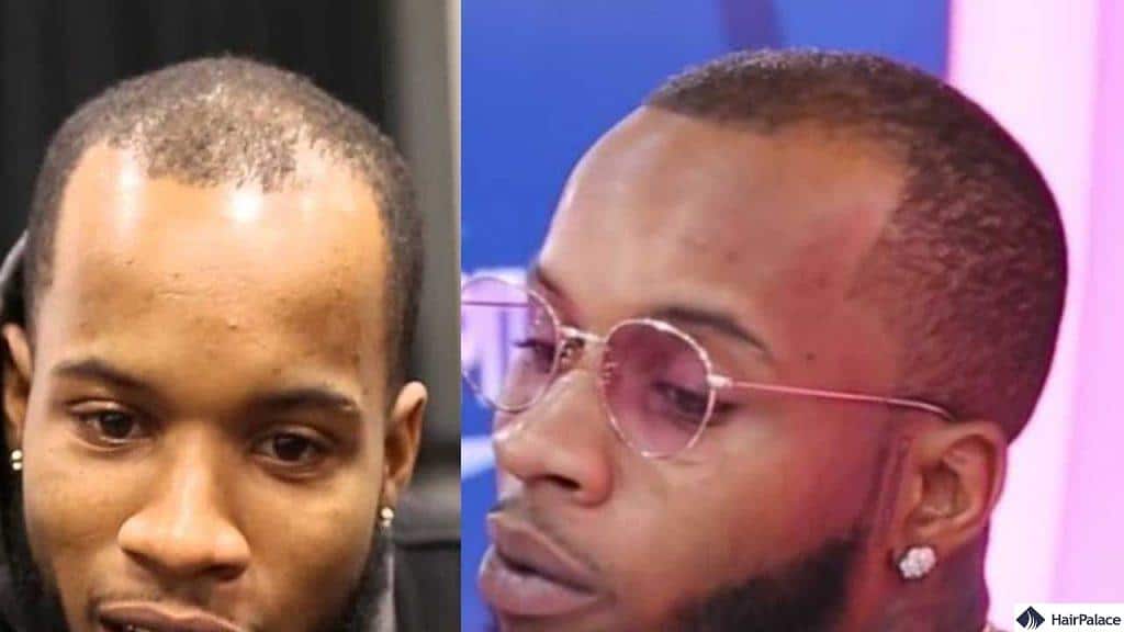 tory lanez hair transplant