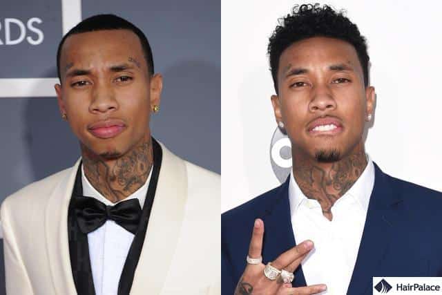 Tyga hair transplant before and after