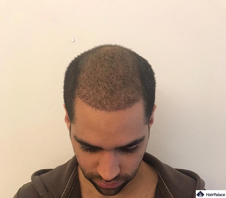 ugly duckling phase hair transplant