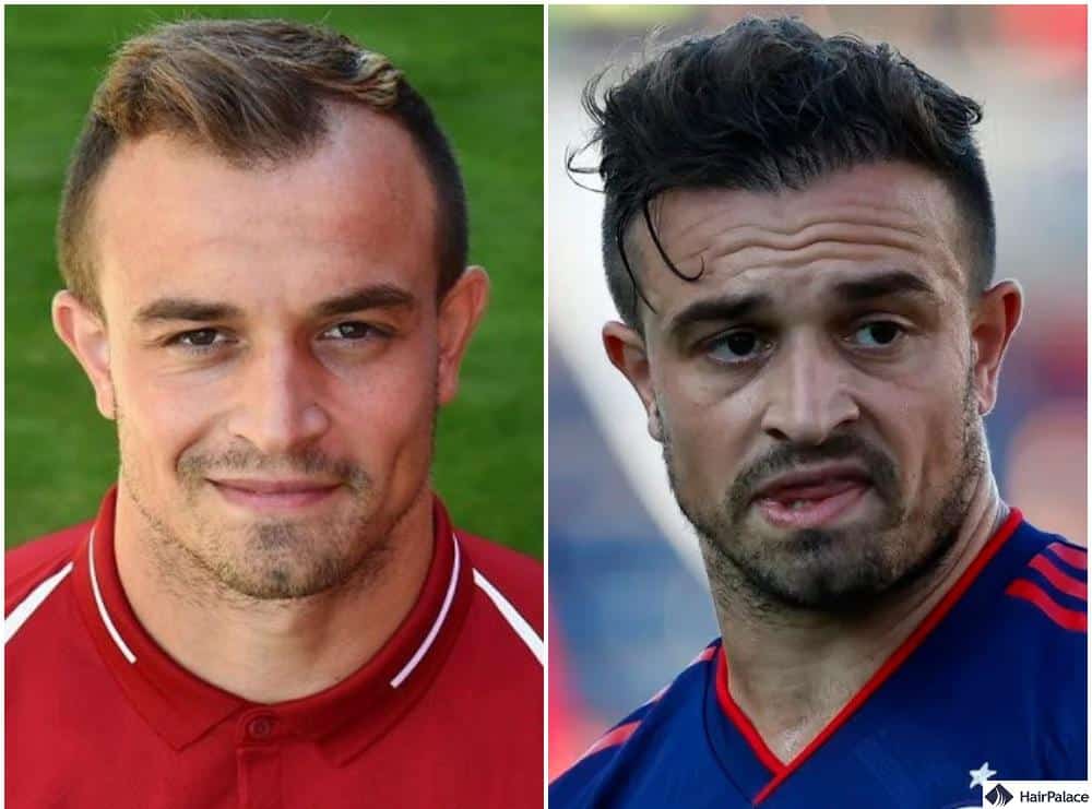 Shaqiri after fue hair transplant with luscious locks