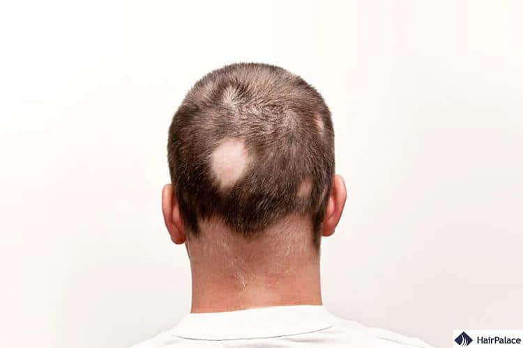 alopecia areata is a common cause of hair loss