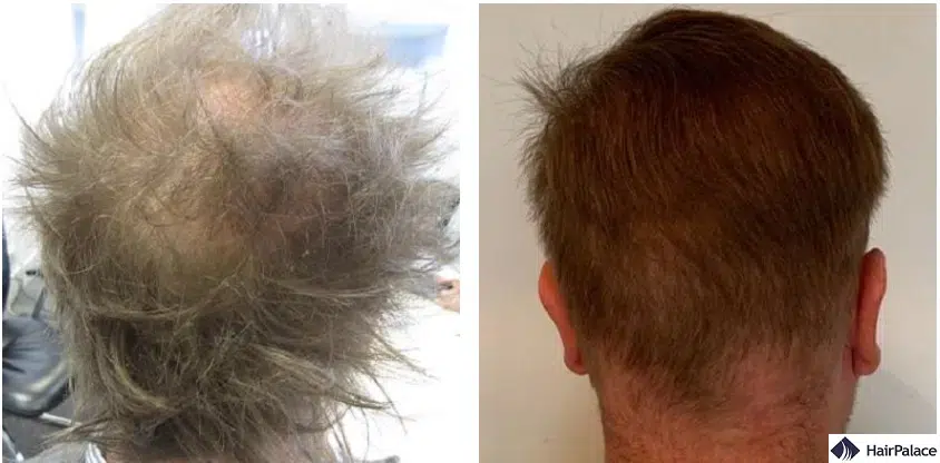 crown hair transplant before and after