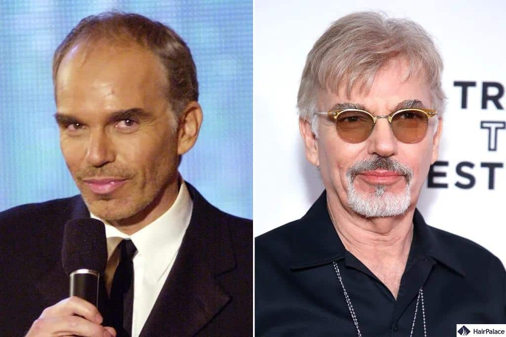 billy bob thorton hair transplant before and after
