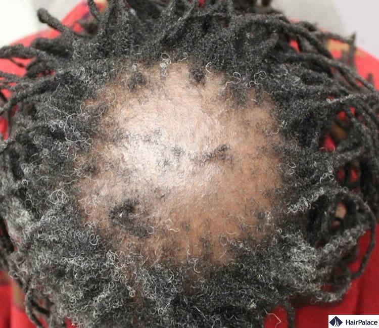 scarring alopecia is a cause of permanent hair loss