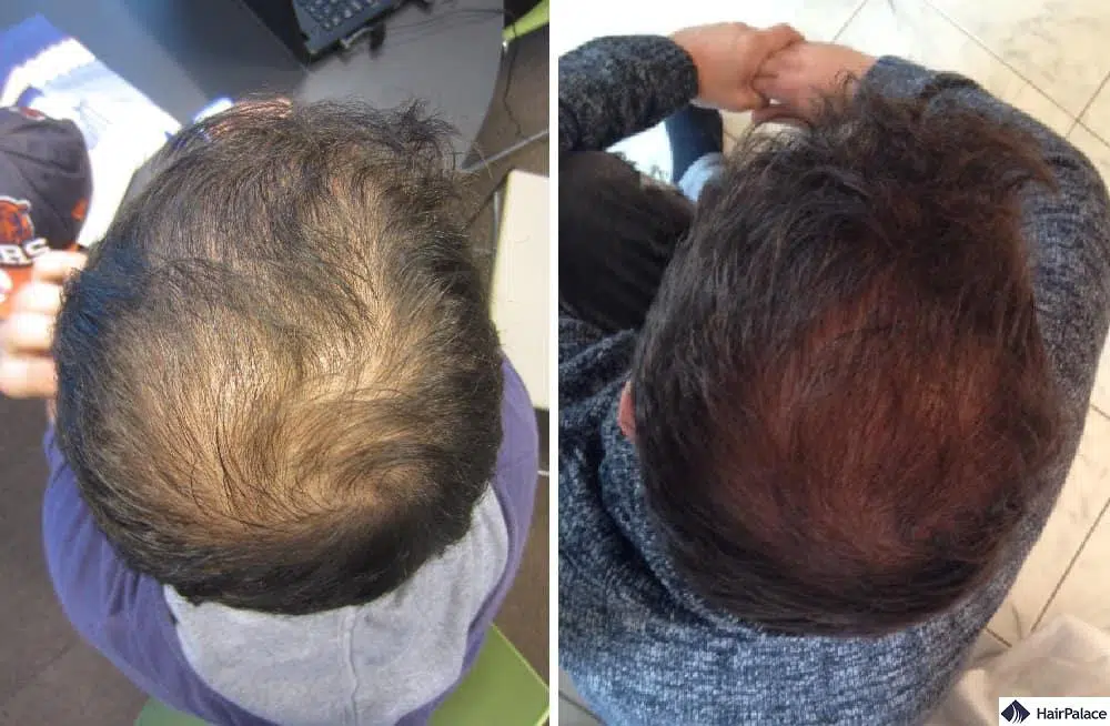 hair transplant crown before and after