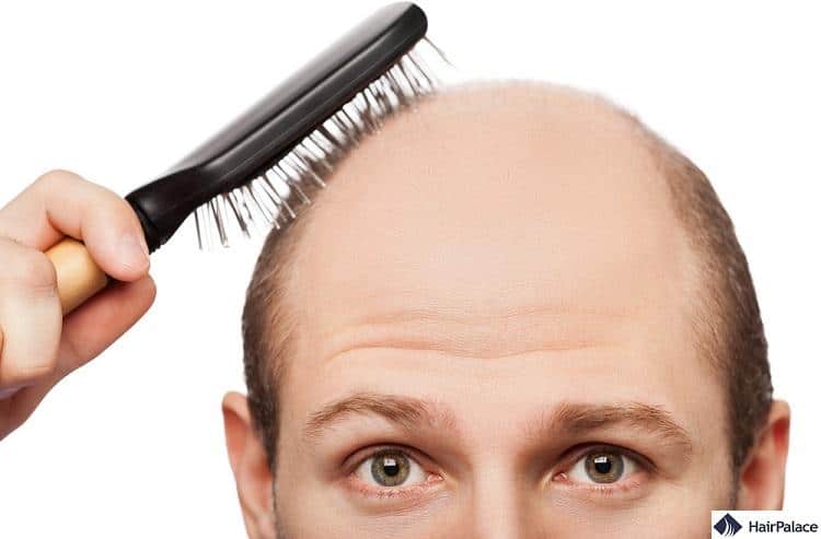 dandruff rarely leads to hair loss or baldness