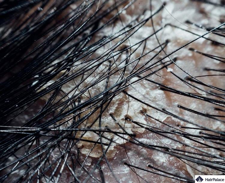 dandruff can be an annoying condition ot deal with, and it may cause an itchy scalp