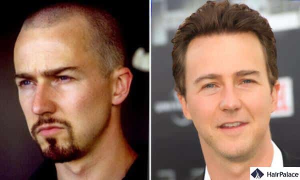 edward norton hair transplant before and after