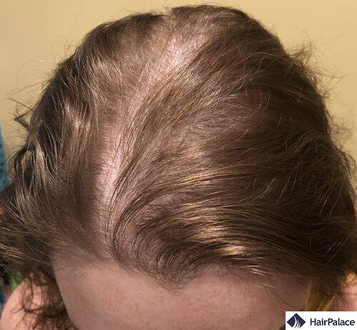 thinning hair on the crown