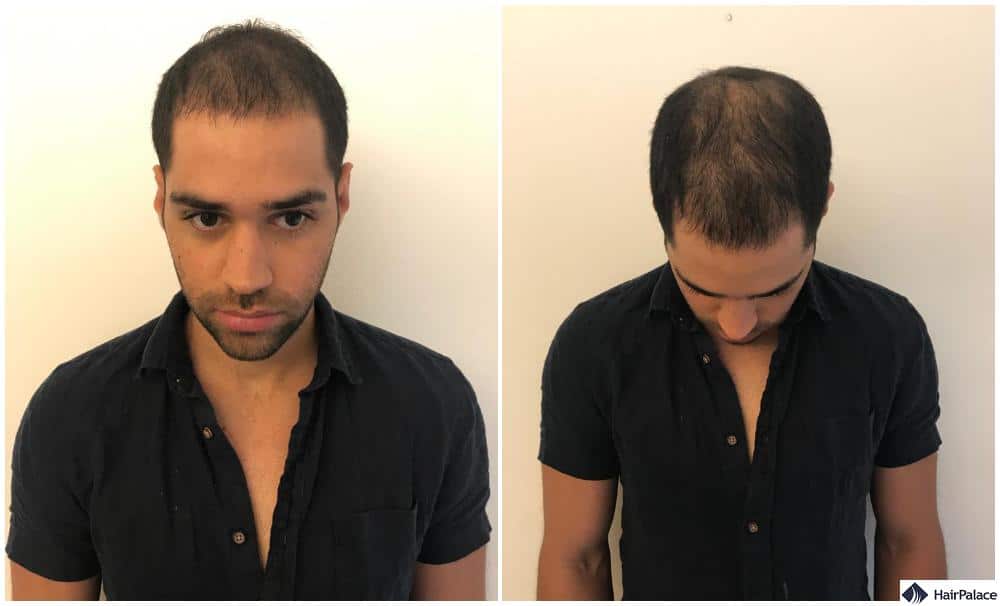 hair grwoth will occur three months after hair transplant