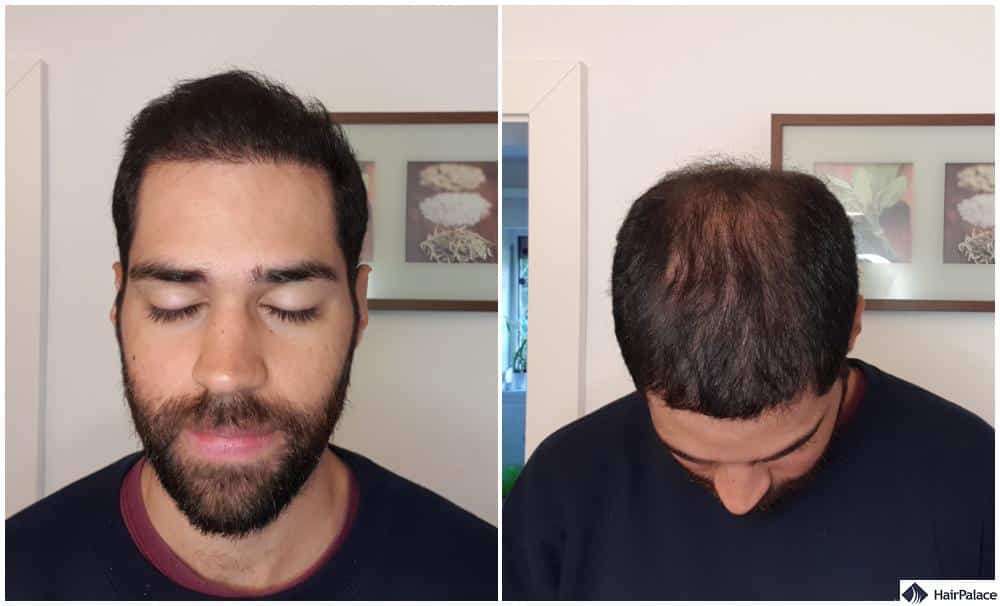 your hair should contineu to thicken at a nice rate 6 months after a hair transplant
