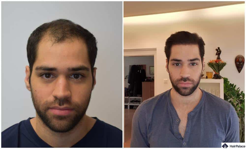 hair transplant results