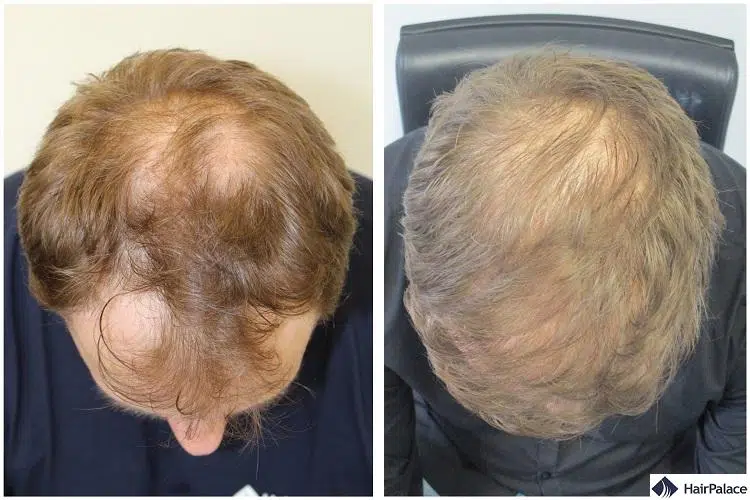 crown hair transplant results
