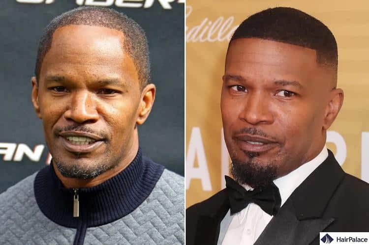 Jamie Fox hair transplant before and after