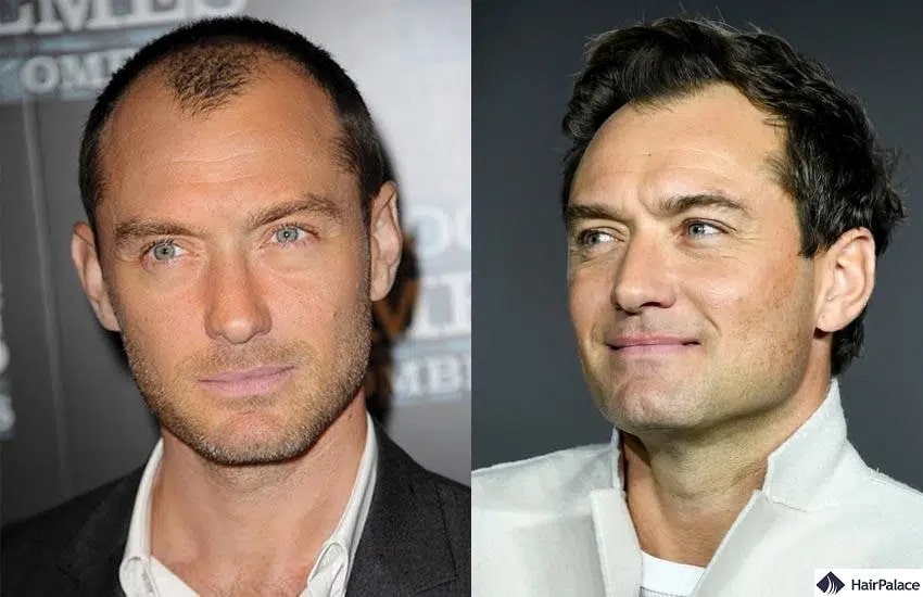 Jude Law hair transplant before and after