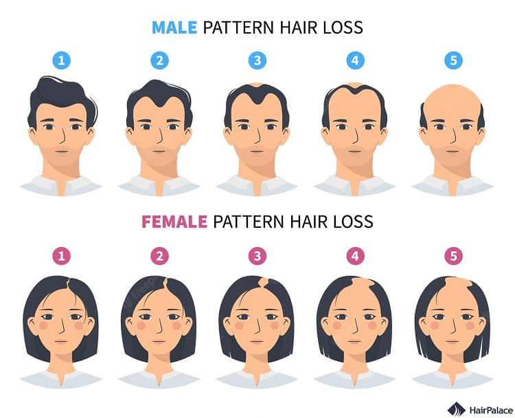 male pattern baldness vs female pattern hair loss