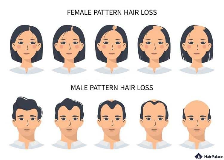 the differences betweeb male pattern baldness and female hair loss