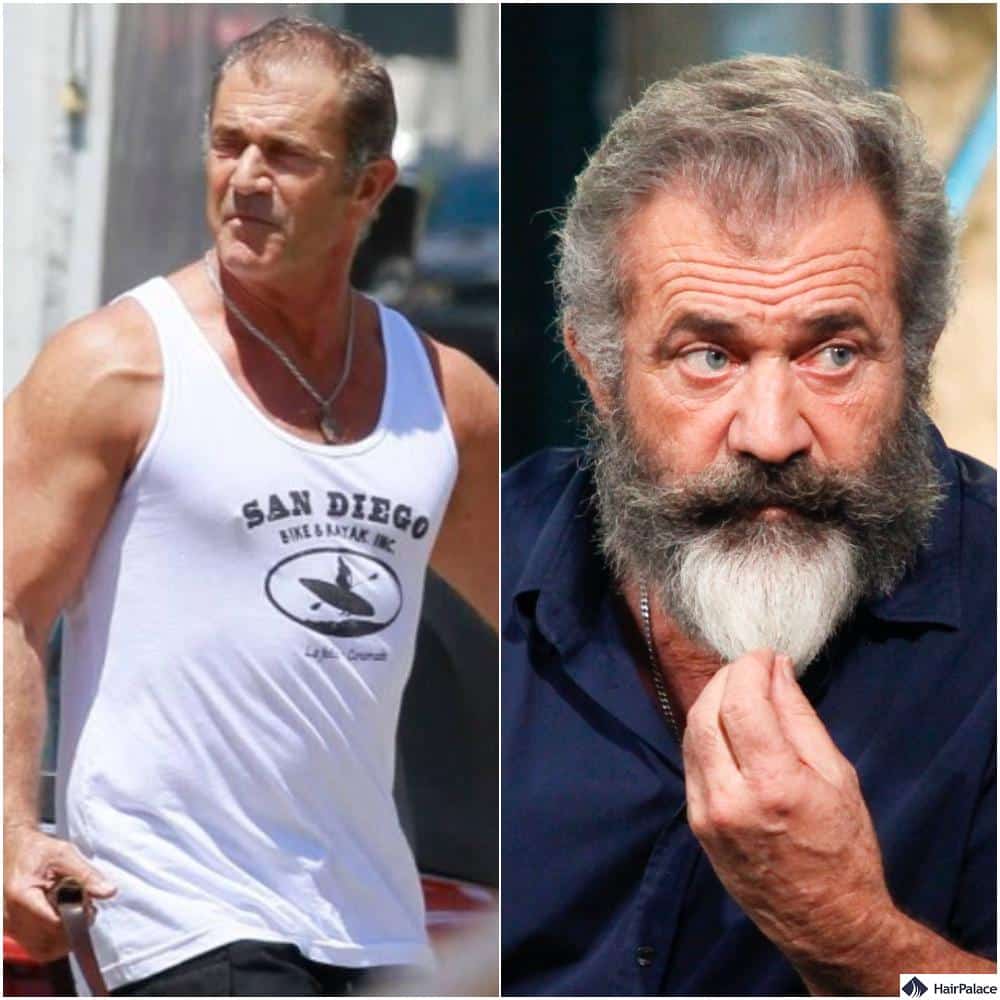 mel gibson had a hair transplant according to rumours