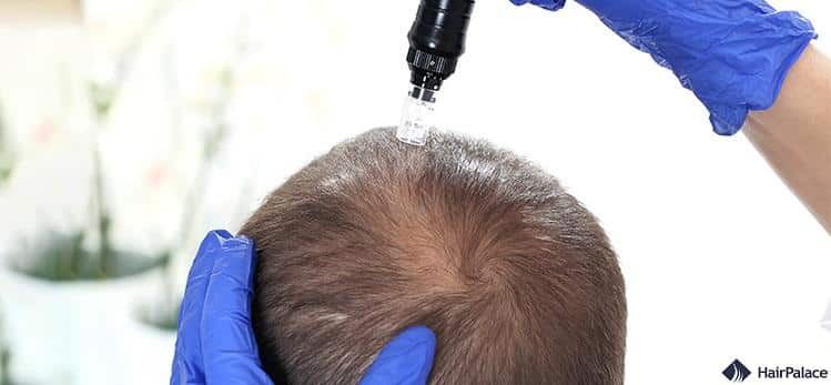 microneedling has several benefits for your hair