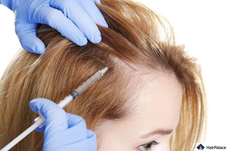 prp is a hair loss treatment