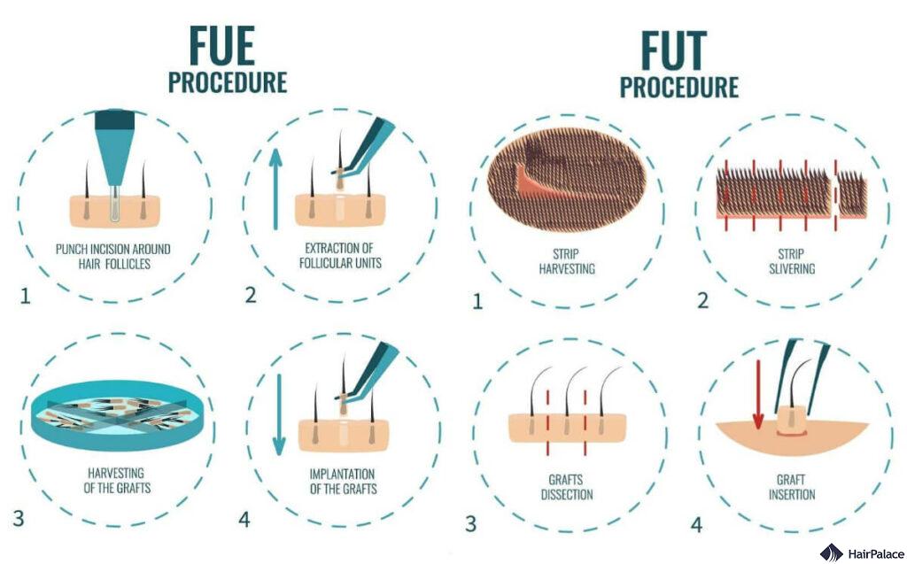 hair transplant methods