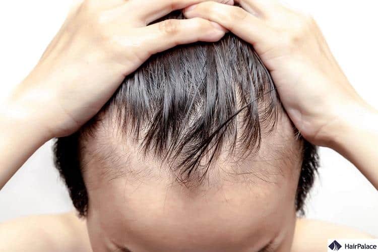 signs of balding at 20