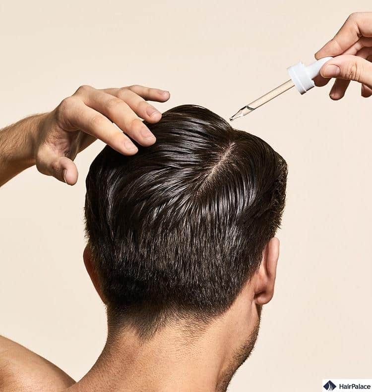 topical fiansteride is a new way to treat hair loss