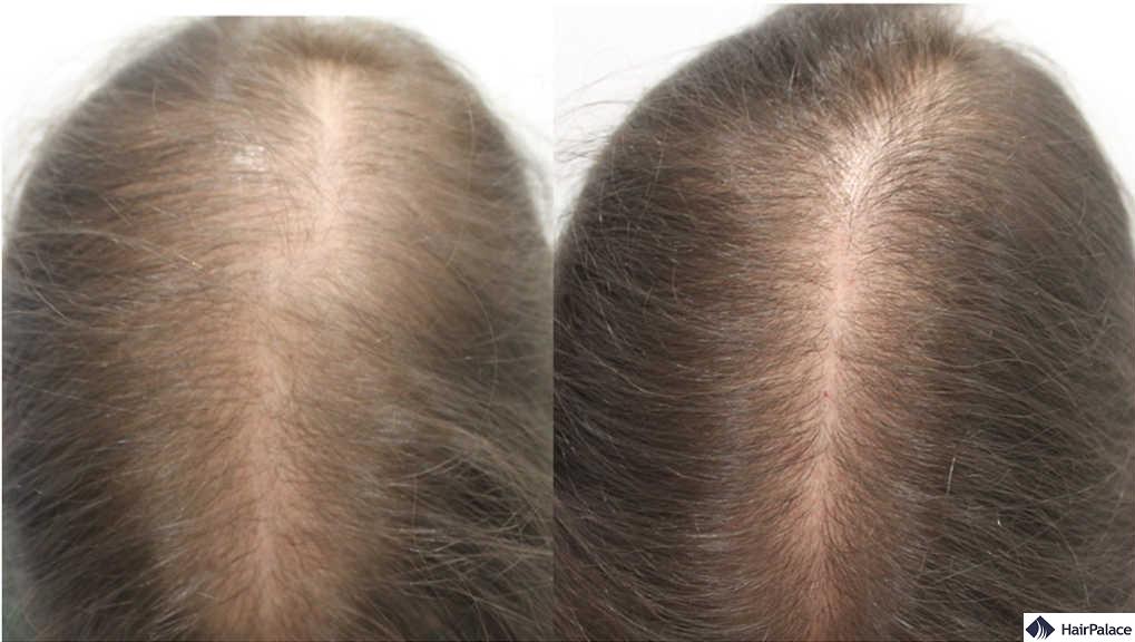 Topical Finasteride for Hair Loss: Efficacy, Side Effects and Results