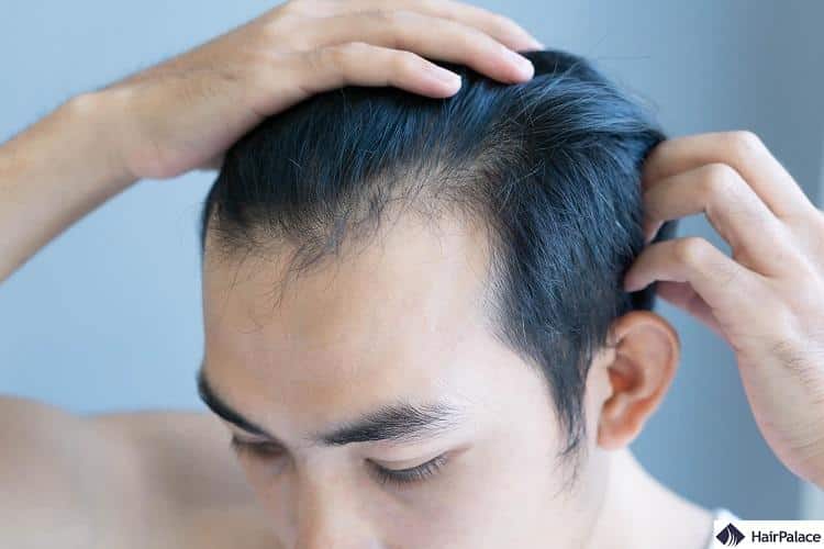 early signs of hair loss can show up in your 20s