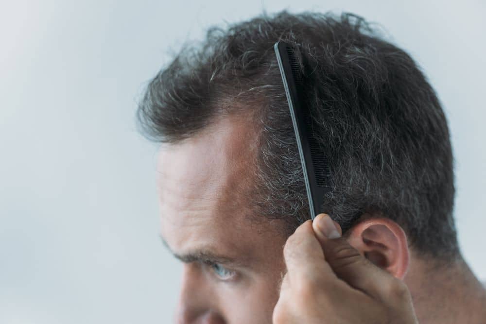 early signs of hair loss can show up in your 20s