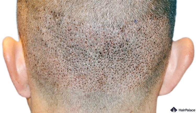 do hair transplant holes ever disappear?